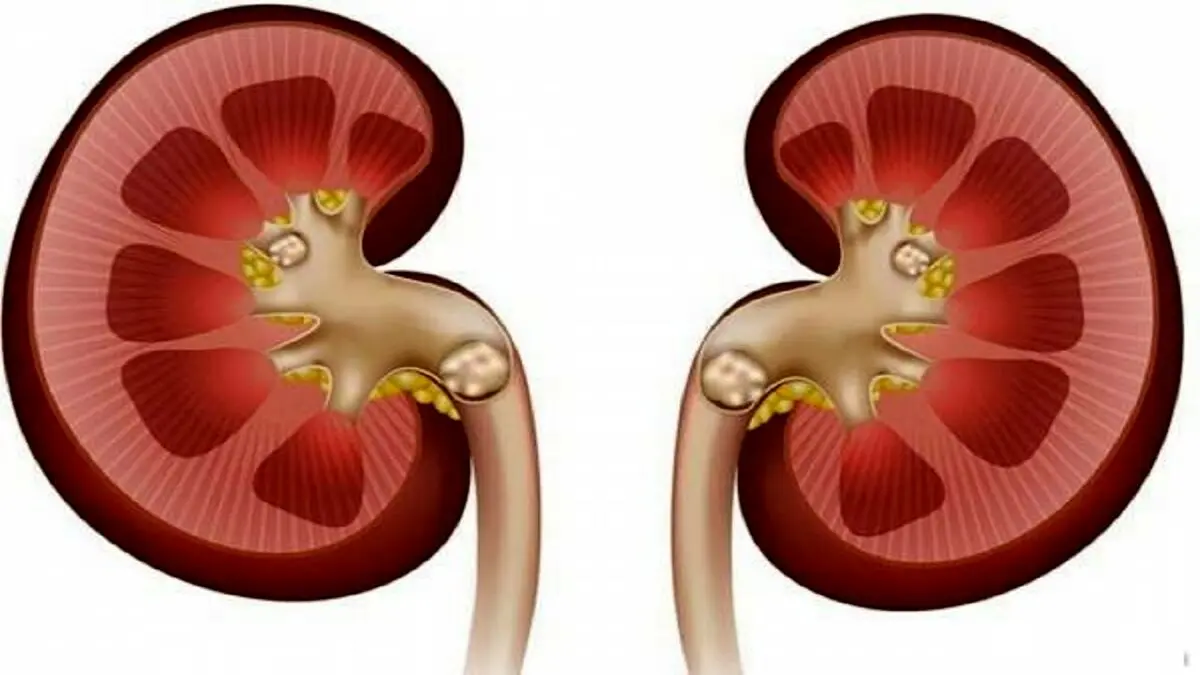 اخبار روز: نشانه های اولیه سنگ کلیه