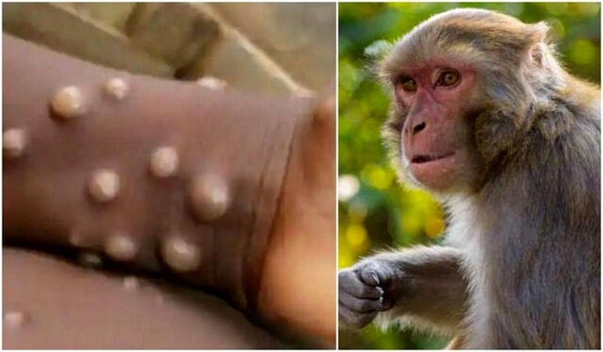 علایم اولیه آبله میمون | طول درمان آبله میمون