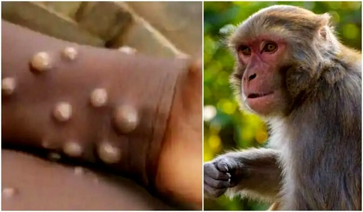 هشدار: علایم عجیب آبله میمون | افزایش آمار آبله میمون
