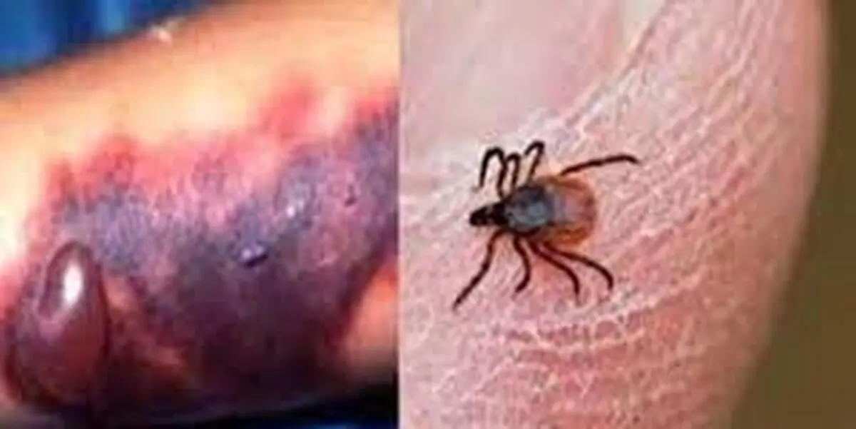 شیوع دوباره بیماری خطرناک جان دو نفر را گرفت + جزئیات بیماری