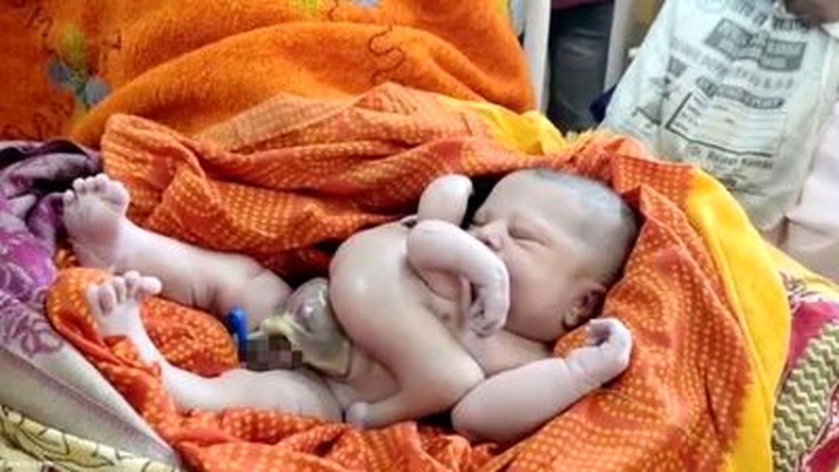 فوری : تولد نوزاد عجیب | نوزاد چهار دست و پا دارد پ ببینید