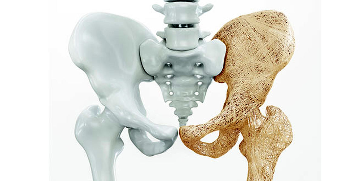 پوکی استخوان را این شکلی درمان کنید | پوکی استخوان چه بلایی سر انسان می آورد؟