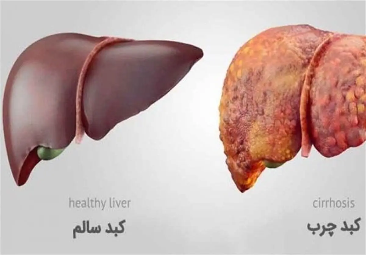 ببینید این خوراکی ها چه بلایی سر کبد می آورند! | برای جلوگیری از کبد چرب باید چه کرد؟